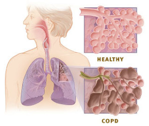 Enroll in a Clinical Trial for COPD