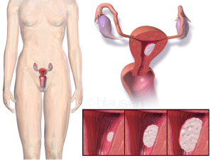 Enroll in a Clinical Trial for Endometrial Cancer