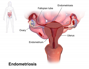 Enroll in a Clinical Trial for Endometriosis