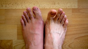 Enroll in a Clinical Trial for Gout