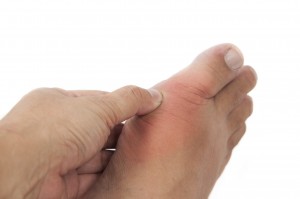 Gout symptoms not entirely relieved by Krystexxa medication during clinical study