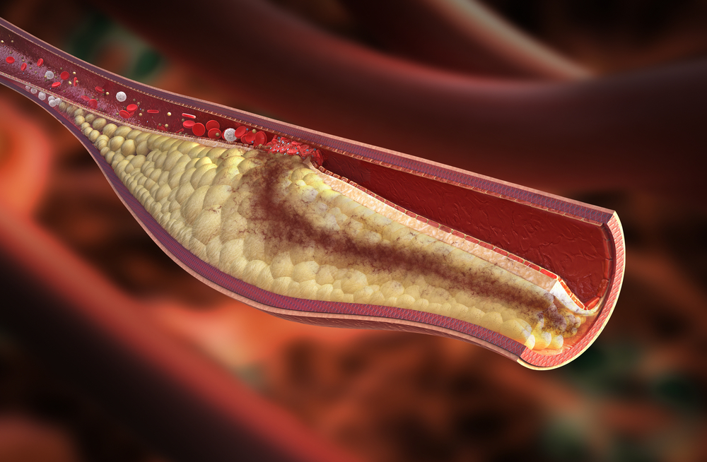 Artery that is blocked due to high cholesterol