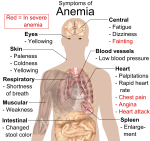 Enroll in a Clinical Trial for Iron Deficiency Anemia