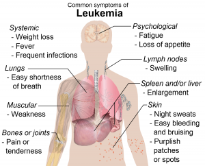 Enroll in a Clinical Trial for Leukemia