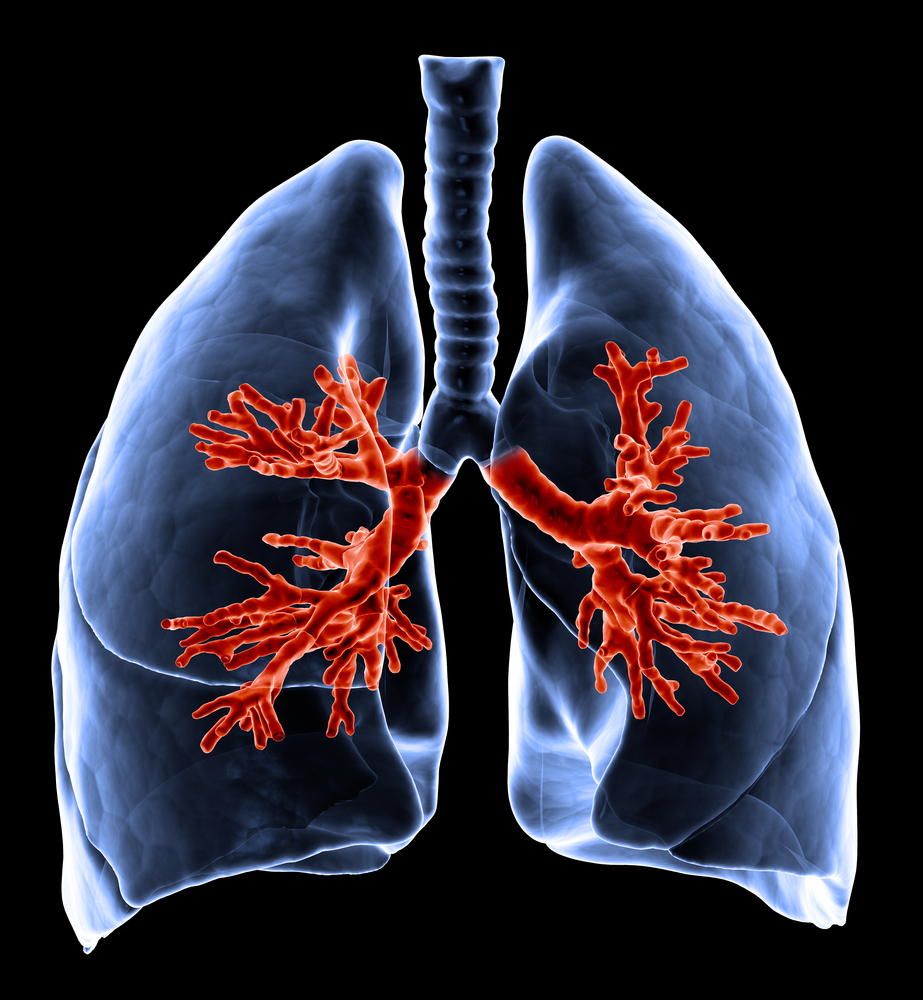 3D image of lungs affected by COPD