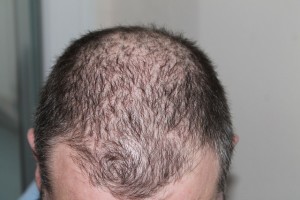 Man experiencing some advanced hair loss